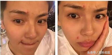 嘴周围长痘痘什么原因导致的（嘴巴周围突然爆痘是为什么）