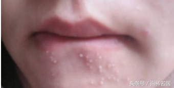 嘴周围长痘痘什么原因导致的（嘴巴周围突然爆痘是为什么）